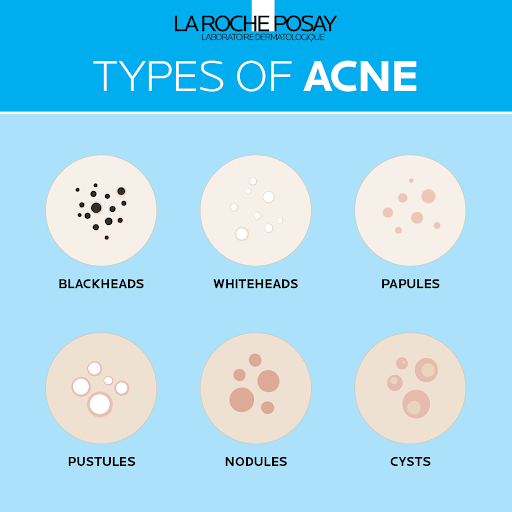 acne-prone_skin_treatment_and_skin_care-2_IMG