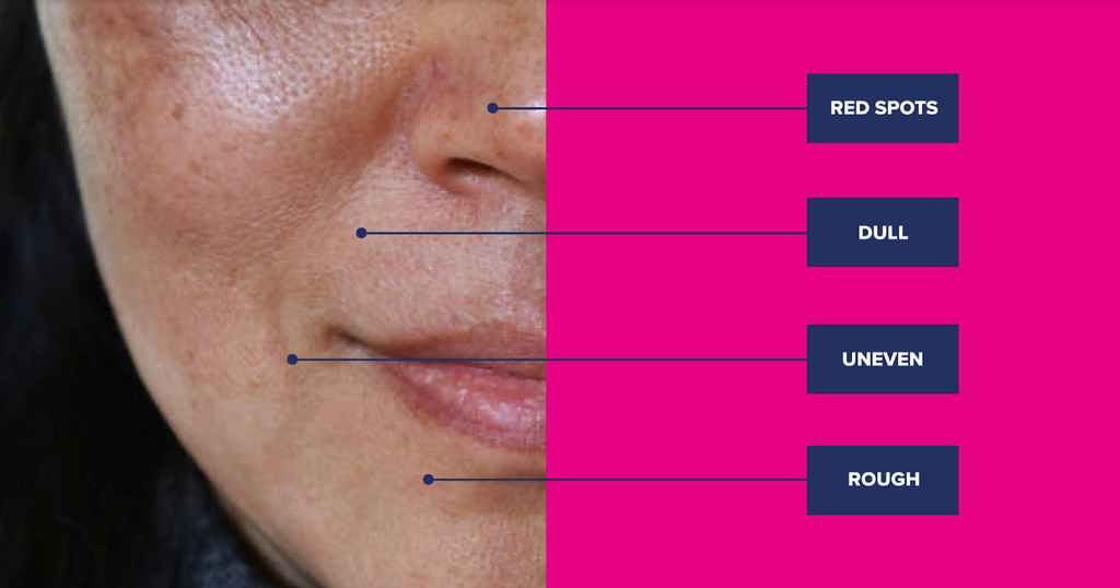 5 Steps to Improve Uneven Skin Texture Tone 1024x1024
