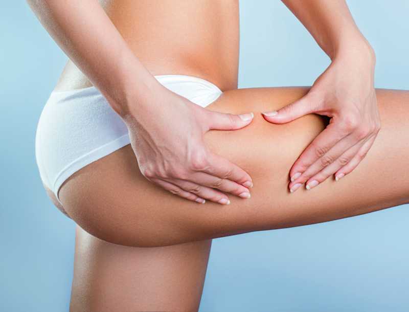 What is cellulite?