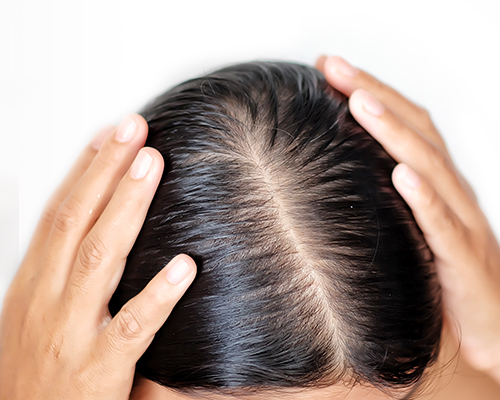 地肌 頭皮 の べたつきをケアしたい H S 地肌 頭皮 の べたつきをケアしたい H S