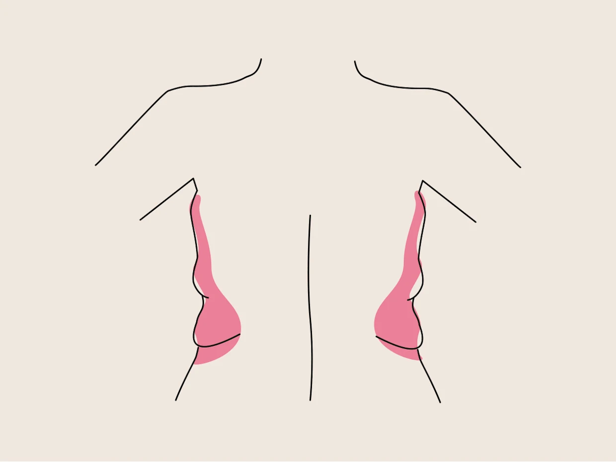 Illustration eines menschlichen Rückens mit rosa hervorgehobenen Bereichen unter den Armen, die Fettdepots darstellen. Illustration eines menschlichen Rückens mit rosa hervorgehobenen Bereichen unter den Armen, die Fettdepots darstellen.