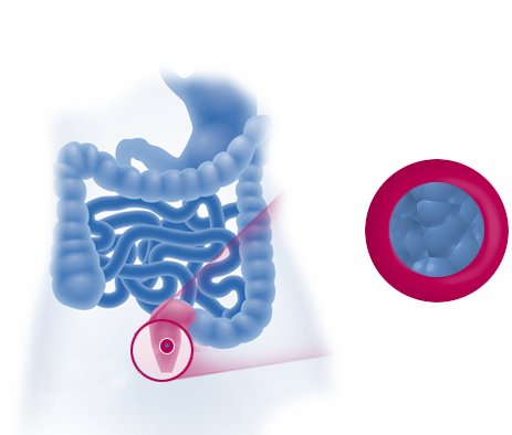 Kovat  ulosteet tekevät suolen tyhjenemisestä vaikeaa