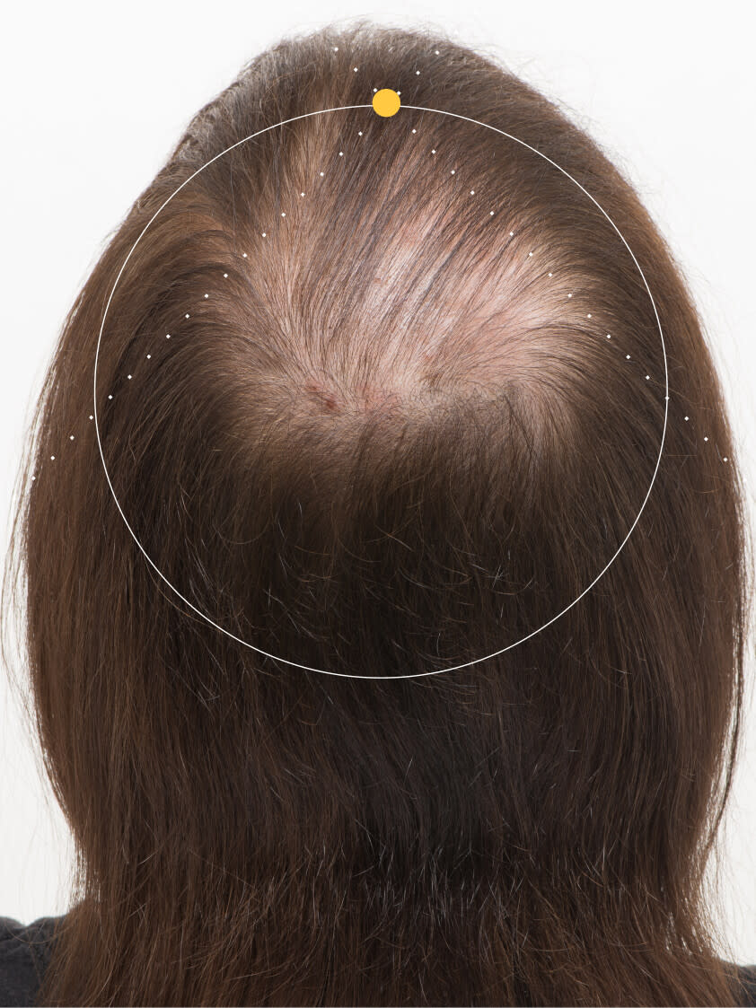 Robert before taking nutrafol men hair growth nutraceutical.