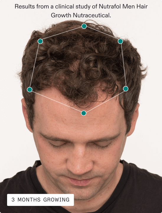 Results from a clinical study of Nutrafol Men Hair Growth Nutraceutical. 3 months growing