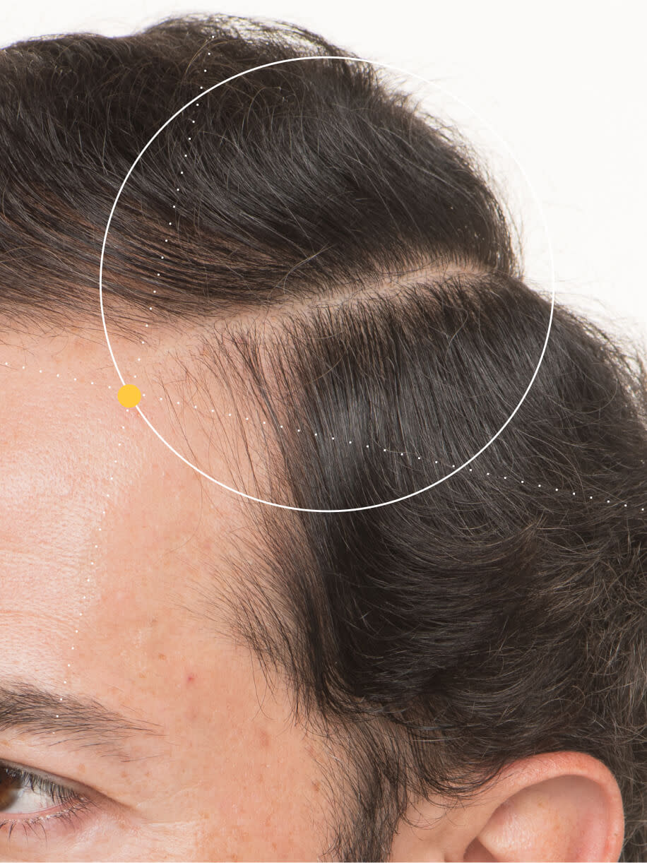 Ottavio 6 months into taking nutrafol men 50+ hair growth nutraceutical.