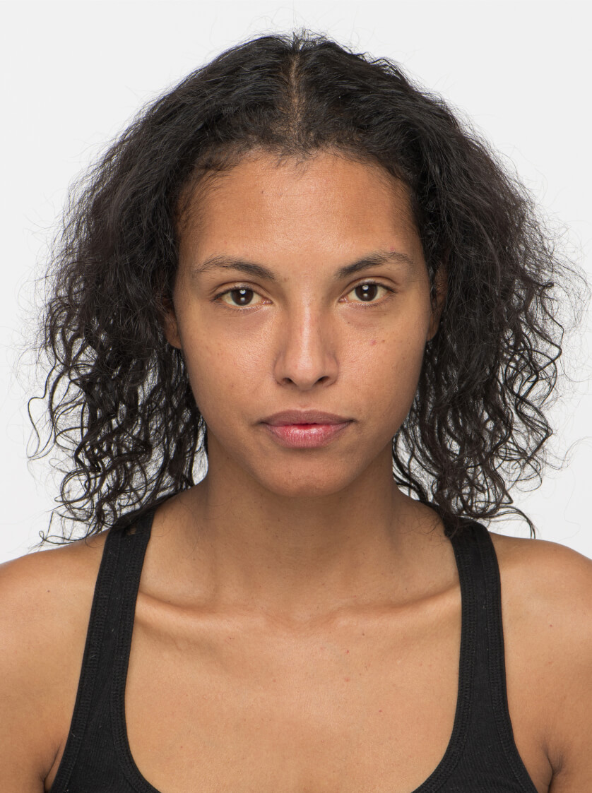 Felisha before taking Nutrafol Women Vegan Hair Growth Nutraceutical.