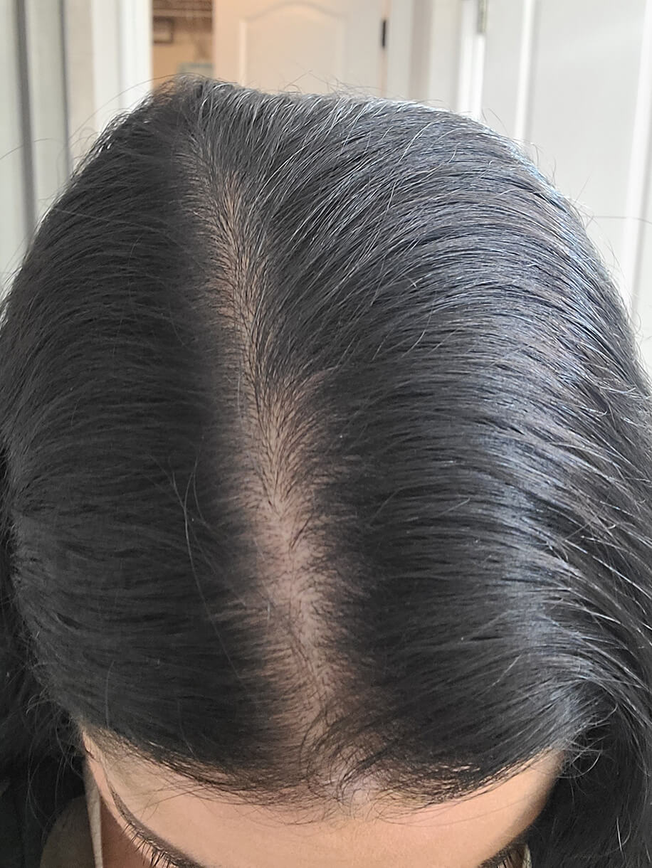Jenny 36 months into taking Nutrafol Women's Balance Hair Growth Nutraceutical. Results are from a clinical study and may vary