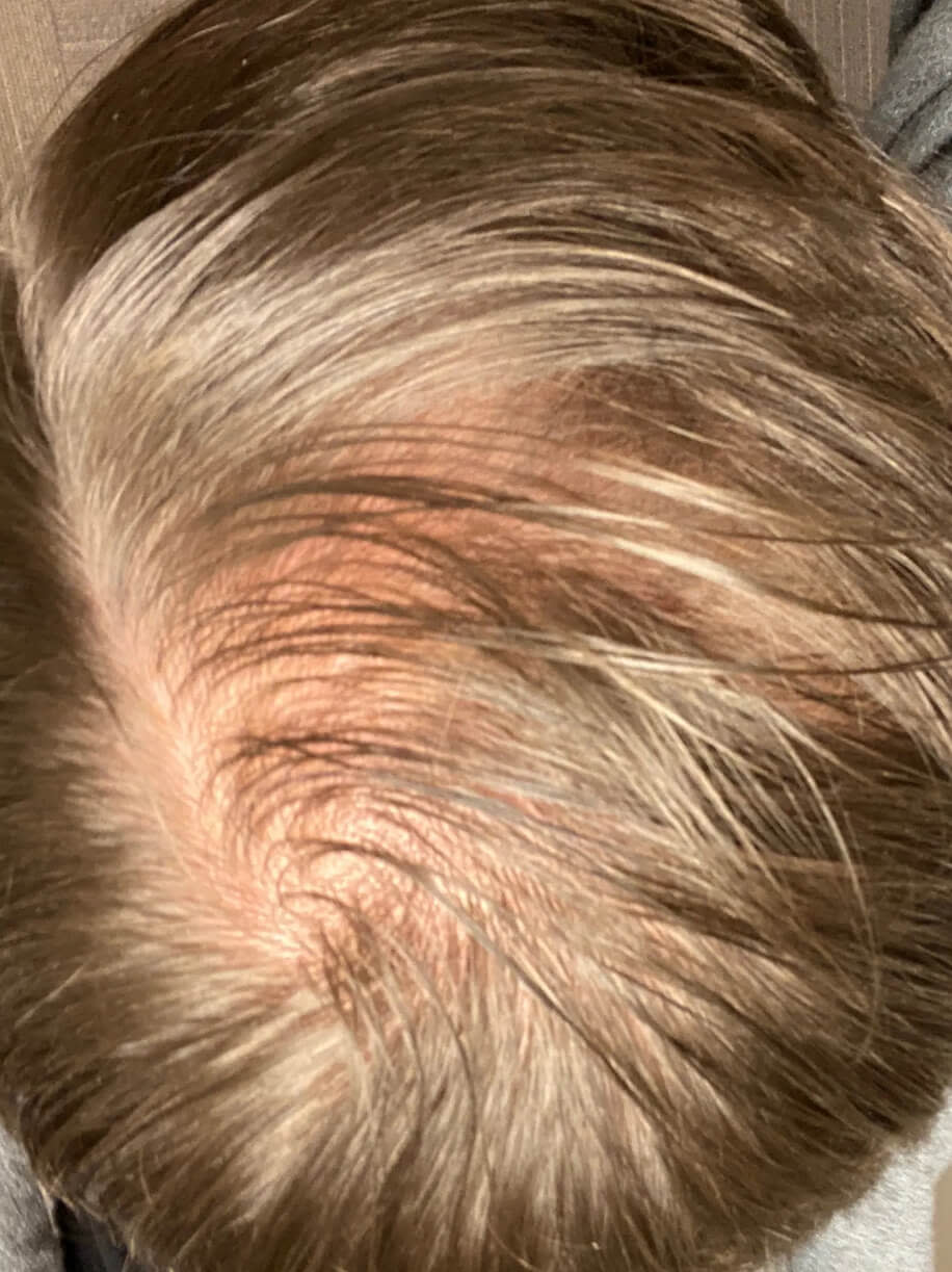 Lance before taking Nutrafol Men Hair Growth Nutraceutical.