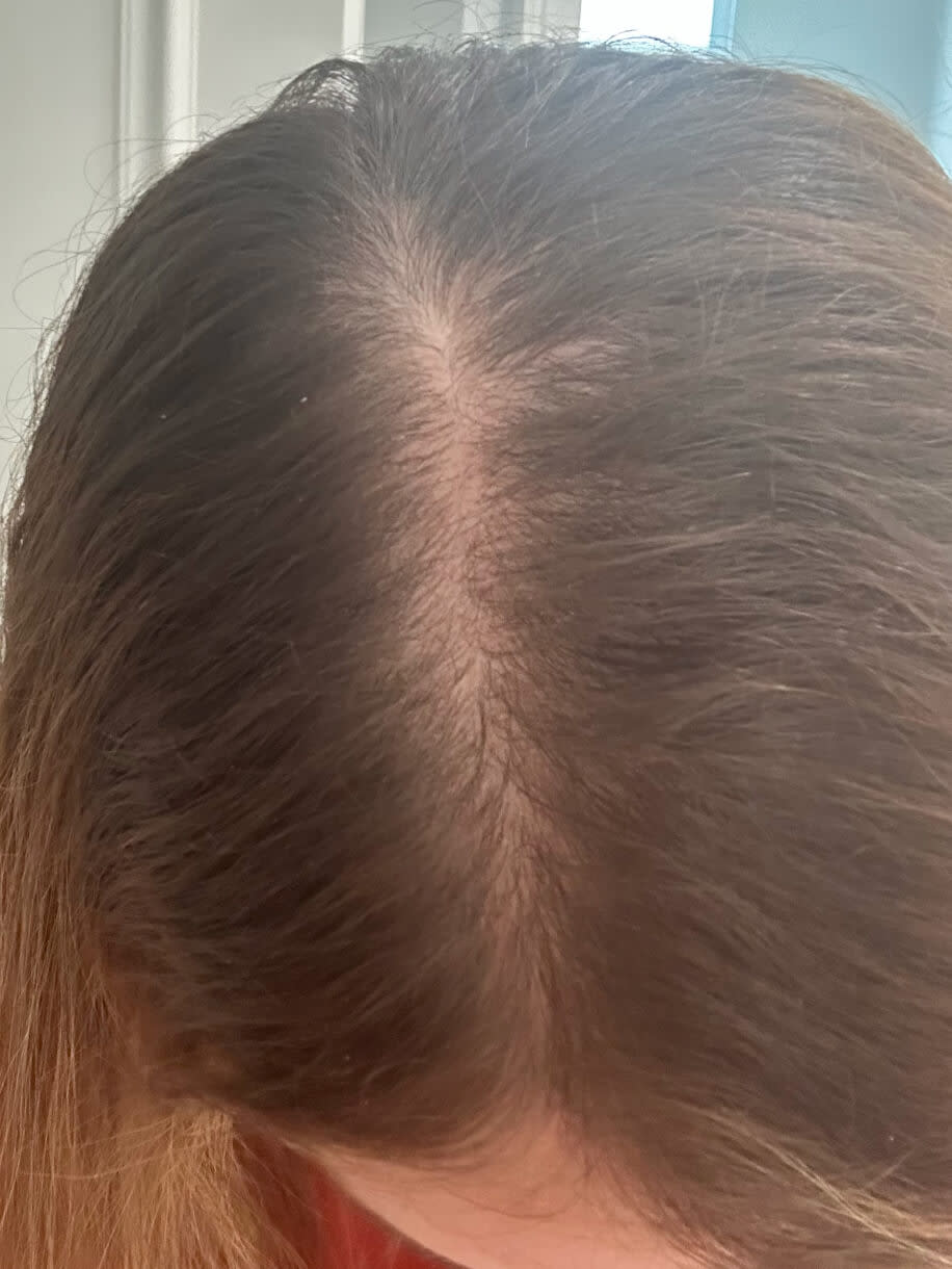 Joanna 5 months into taking Nutrafol Women Hair Growth Nutraceutical. Results are from a clinical study and may vary