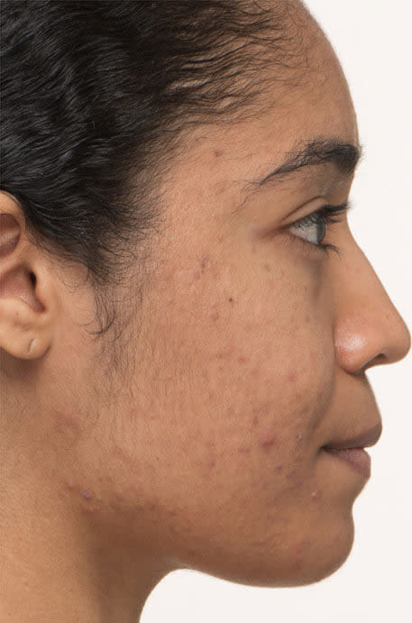 Kayla after 4 weeks taking Nutrafol Clear Skin Nutraceutical.