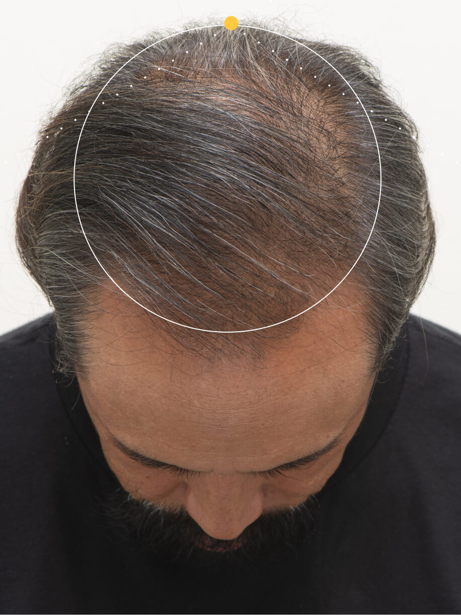 RICHARD 9 months into taking Nutrafol Men 50+ Hair Growth Nutraceutical. Results are from a clinical study and may vary