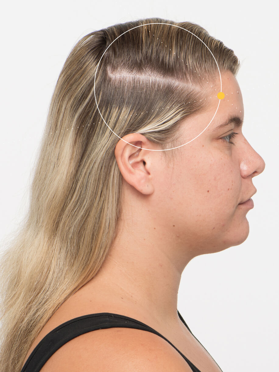 Ensley before taking Nutrafol Women Hair Growth Nutraceutical.