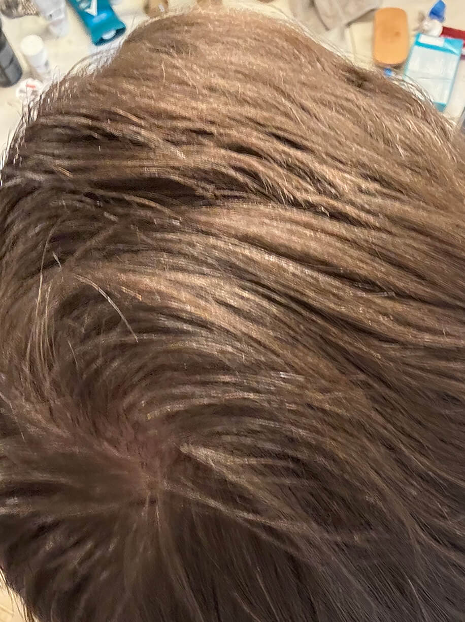 Lance 3.5 months into taking Nutrafol Men Hair Growth Nutraceutical. Results are from a clinical study and may vary