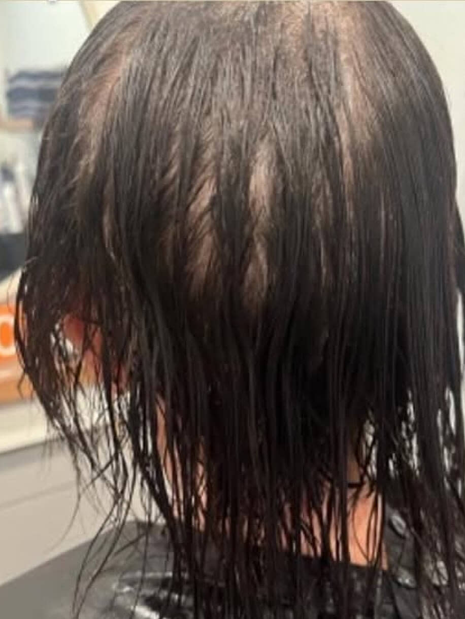 Karla before taking Nutrafol Women's Balance Hair Growth Nutraceutical.