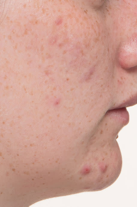 Emily before taking Nutrafol Clear Skin Nutraceutical.