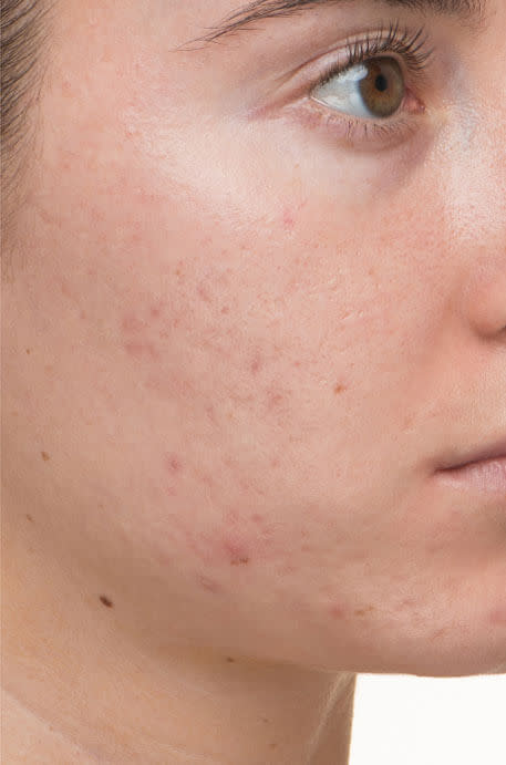 Lindsey after 12 weeks taking Nutrafol Clear Skin Nutraceutical.