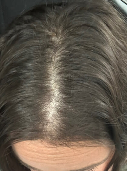 Lisa before taking Nutrafol Women Hair Growth Nutraceutical.