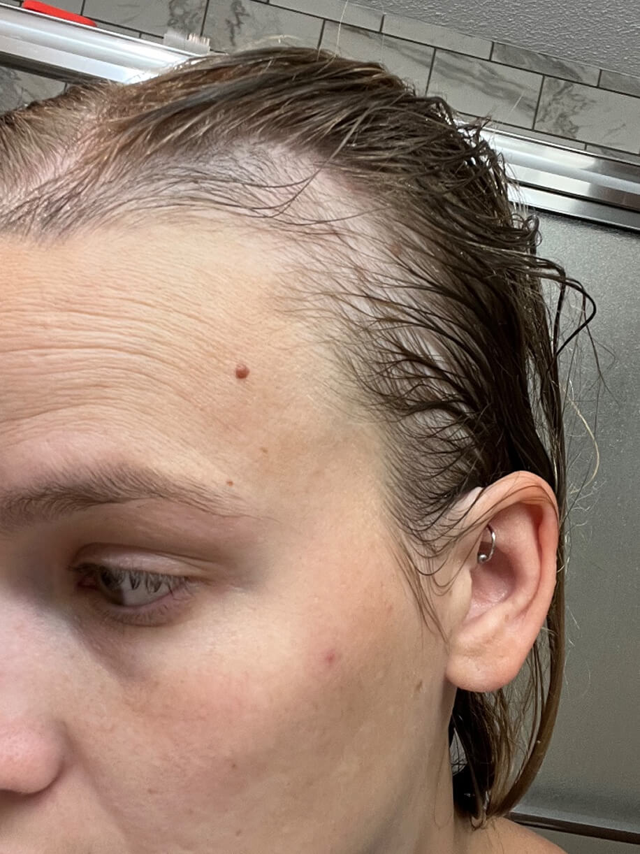 Ashlyn before taking Nutrafol Postpartum Hair Growth Nutraceutical.