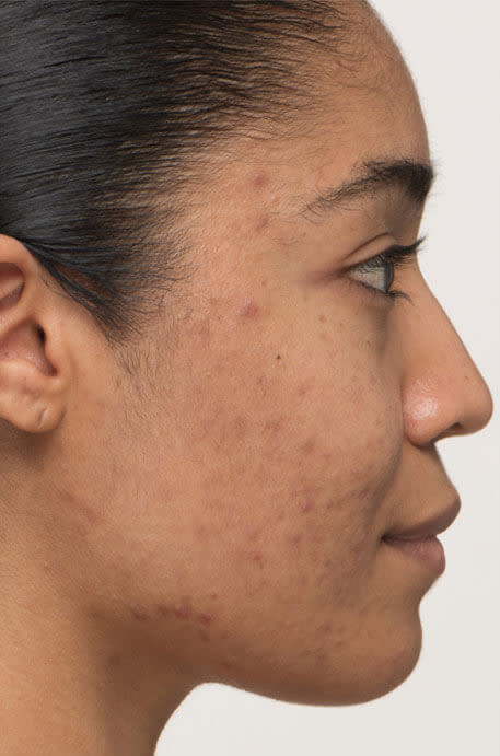 Kayla before taking Nutrafol Clear Skin Nutraceutical.