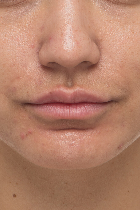 Casey after 8 weeks taking Nutrafol Clear Skin Nutraceutical.