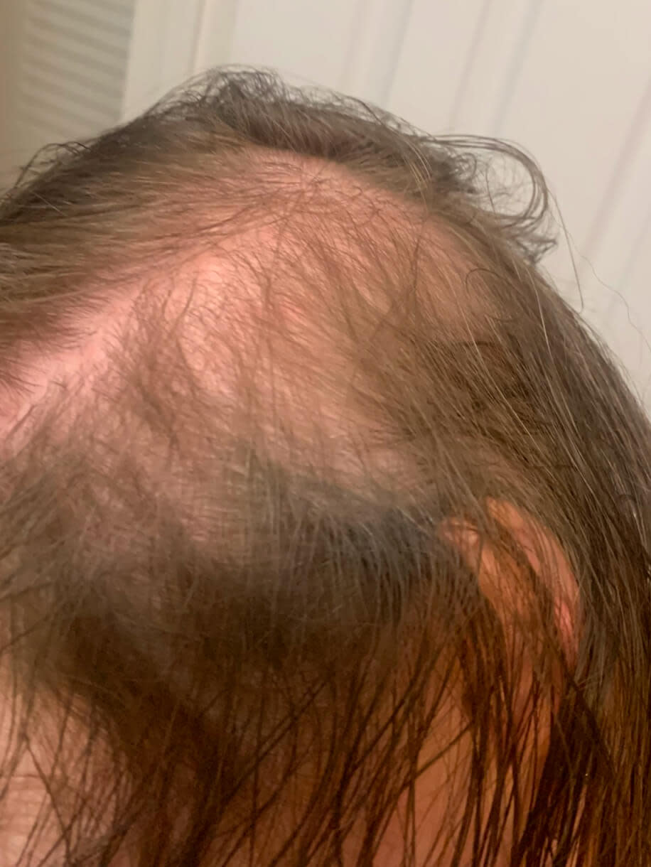 Crystal before taking Nutrafol Women Hair Growth Nutraceutical.