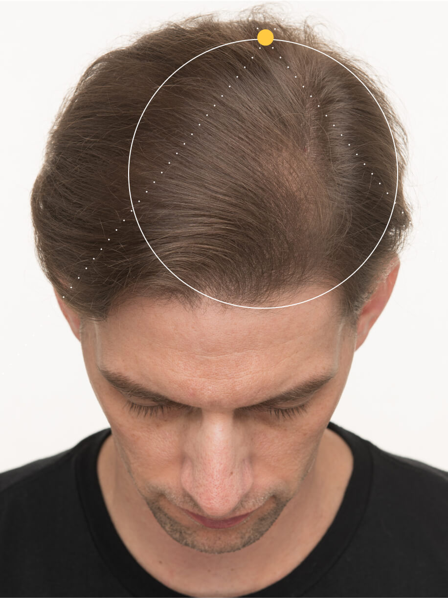 Sam 3 months into taking Nutrafol Men Hair Growth Nutraceutical. Results are from a clinical study and may vary