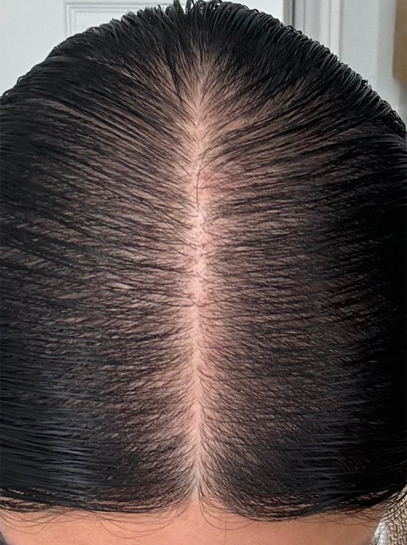 Melanie 8 months into taking Nutrafol Women’s Vegan Hair Growth Nutraceutical. Results are from a clinical study and may vary