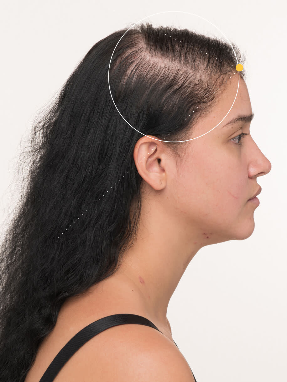 Lilyana before taking Nutrafol Postpartum Hair Growth Nutraceutical.