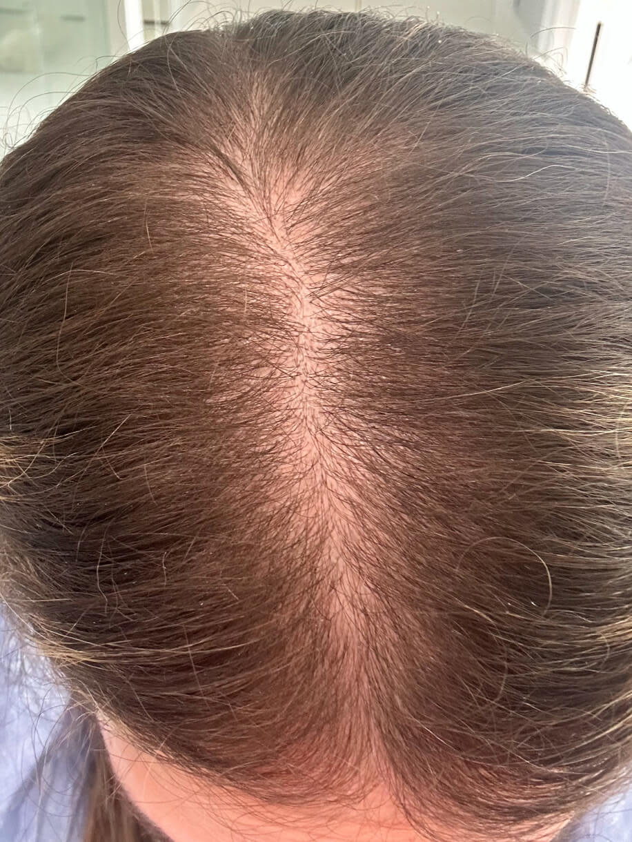 Joanna before taking Nutrafol Women Hair Growth Nutraceutical.