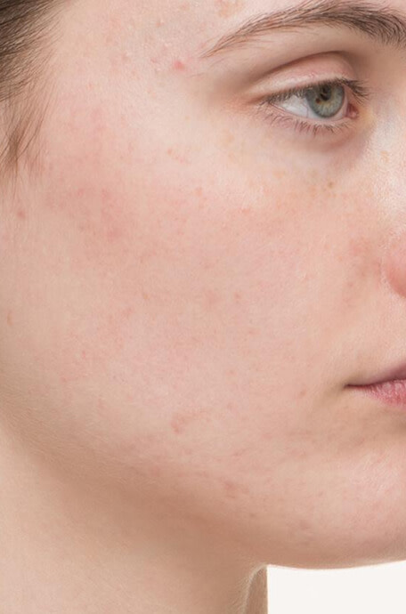 Chloe after 8 weeks taking Nutrafol Clear Skin Nutraceutical.