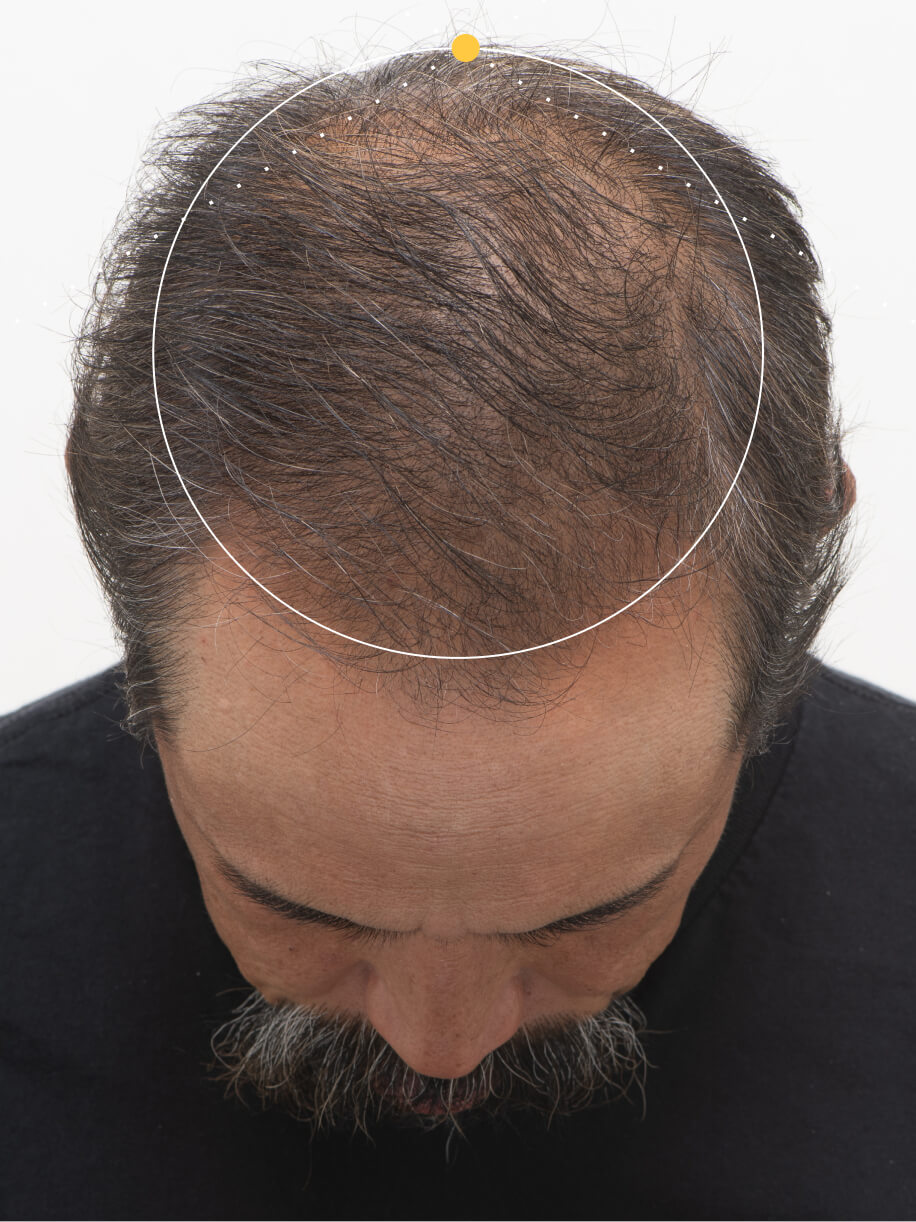 RICHARD before taking Nutrafol Men 50+ Hair Growth Nutraceutical.