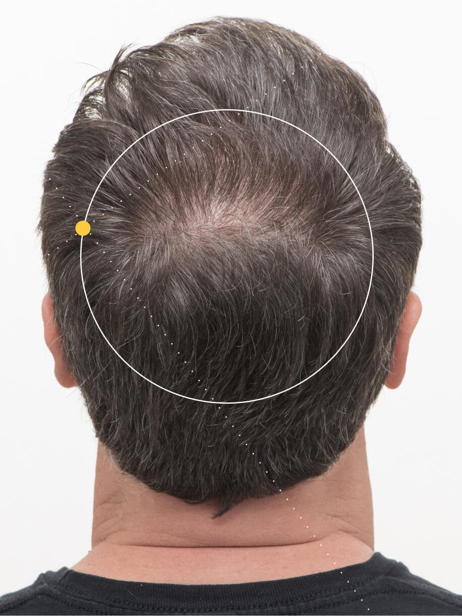 David before taking Nutrafol Men 50+ Hair Growth Nutraceutical.