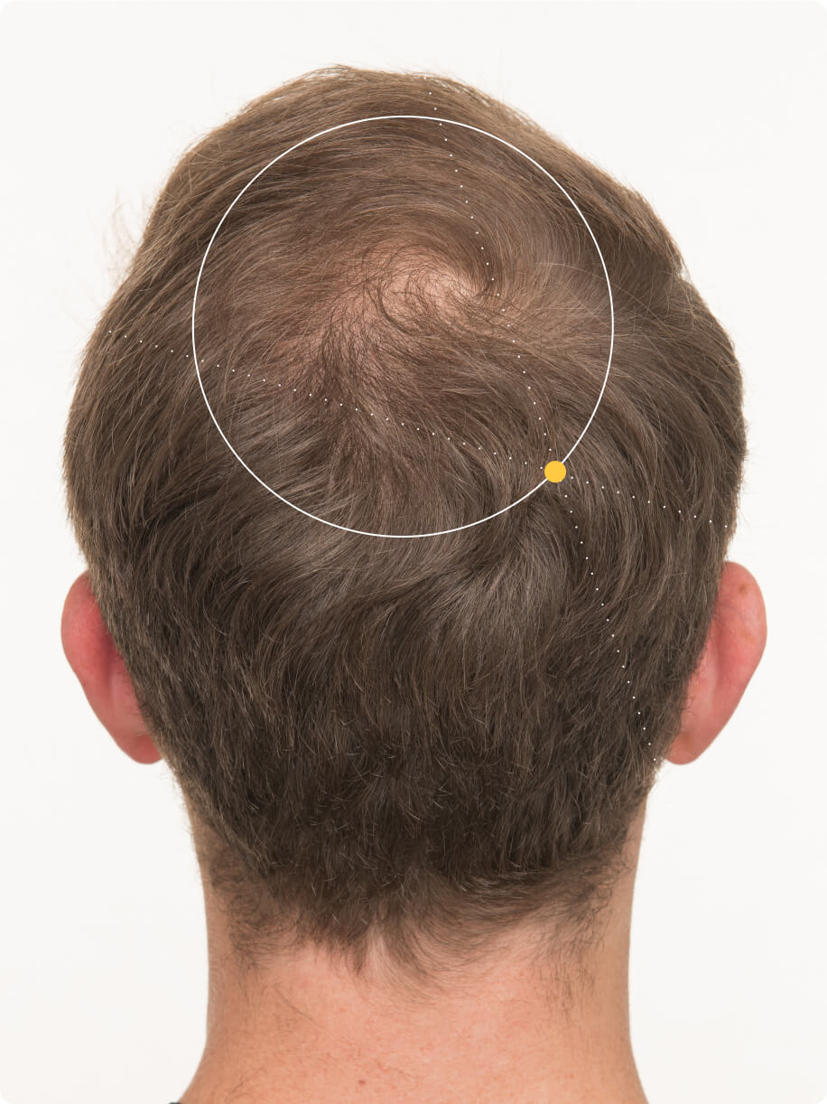 Tanner 3 months into taking Nutrafol Men Hair Growth Nutraceutical. Results are from a clinical study and may vary