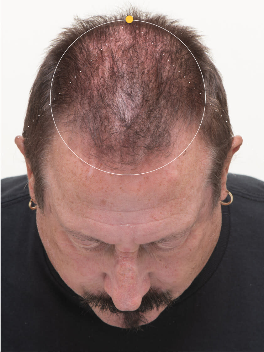 Gordon 9 months into taking nutrafol men 50+ hair growth nutraceutical.