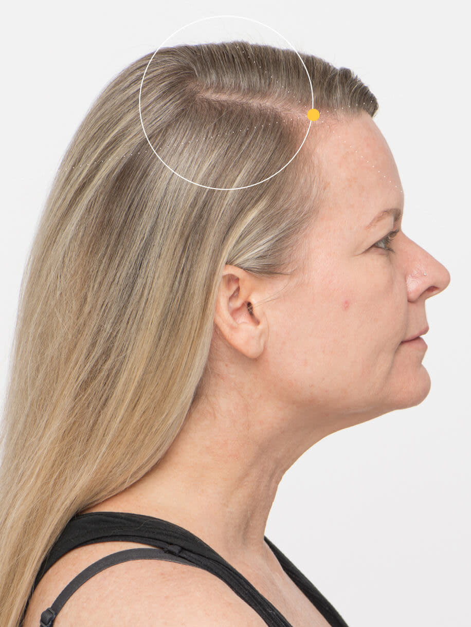 Naomi before taking Nutrafol Women’s Vegan Hair Growth Nutraceutical.