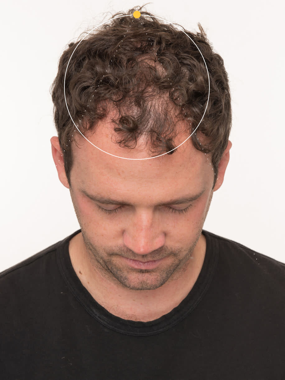 Brian before taking Nutrafol Men Hair Growth Nutraceutical.