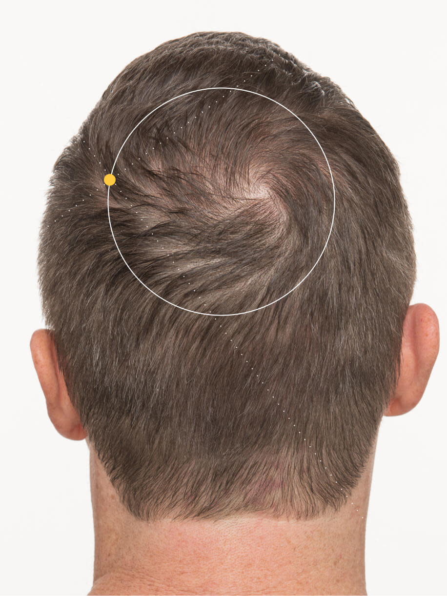 Jim before taking Nutrafol Men Hair Growth Nutraceutical.