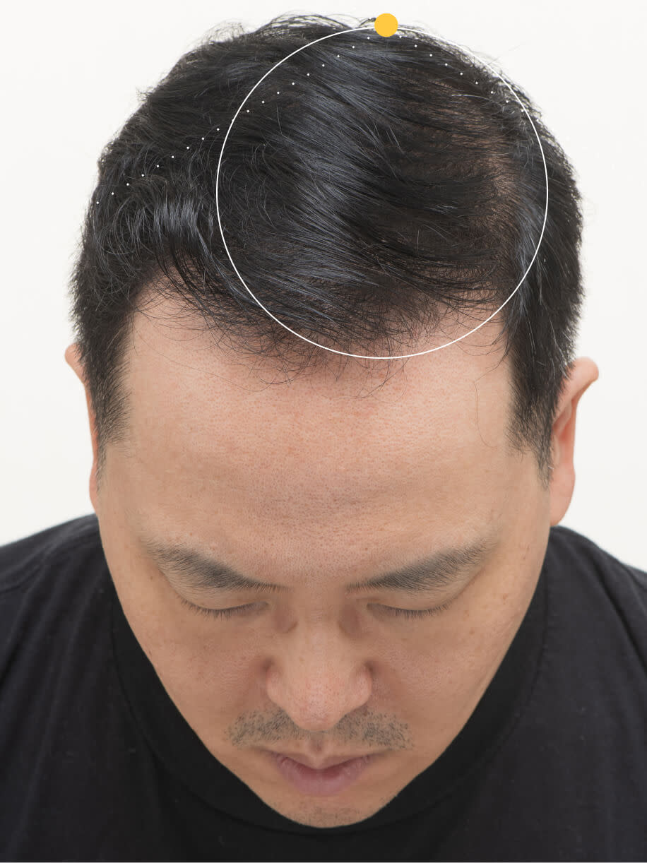 Stephen 9 months into taking nutrafol men 50+ hair growth nutraceutical.