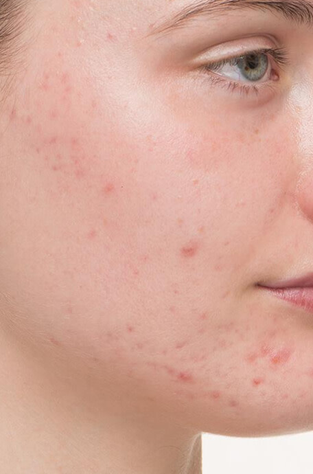 Chloe before taking Nutrafol Clear Skin Nutraceutical.