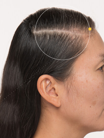 Karin before taking Nutrafol Women Balance Hair Growth Nutraceutical.