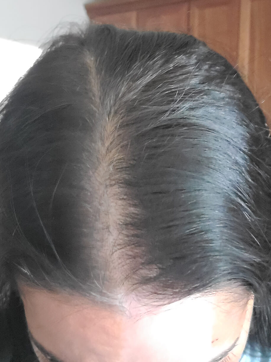 Jenny before taking Nutrafol Women's Balance Hair Growth Nutraceutical.