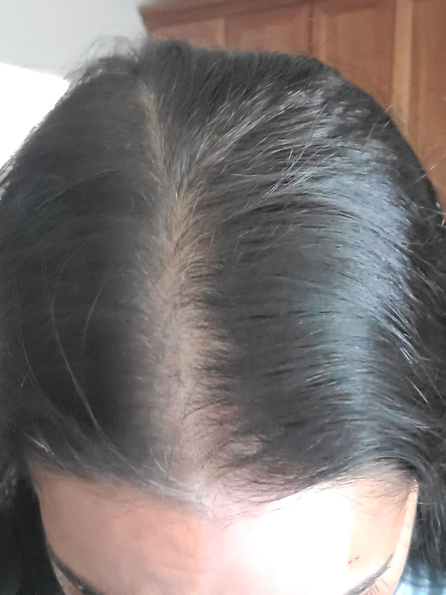 Jenny before taking Nutrafol Women's Balance Hair Growth Nutraceutical.