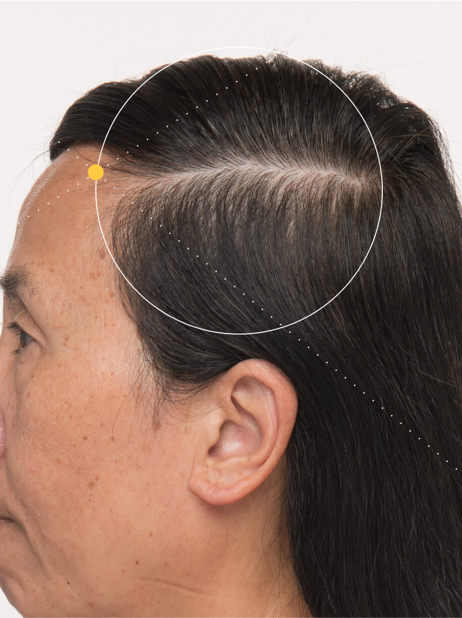 Heidi before taking Nutrafol Women Balance Hair Growth Nutraceutical.