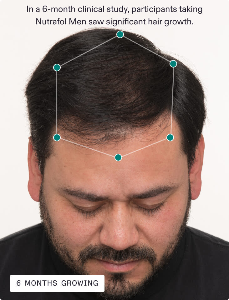 Jose’s scalp 6 months growing with Nutrafol.