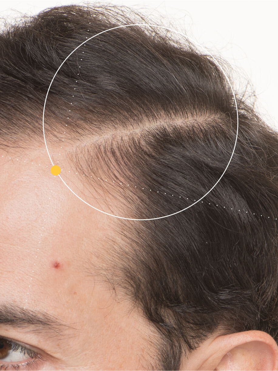 OTTAVIO before taking Nutrafol Men 50+ Hair Growth Nutraceutical.