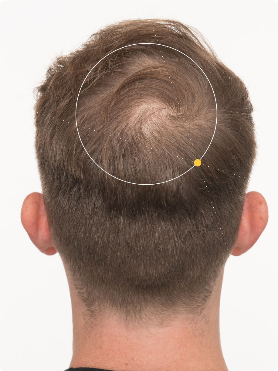 Tanner before taking Nutrafol Men Hair Growth Nutraceutical.