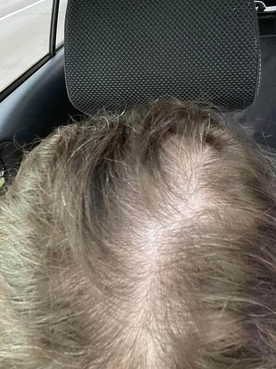 Jodi before taking Nutrafol Women’s Balance Hair Growth Nutraceutical.