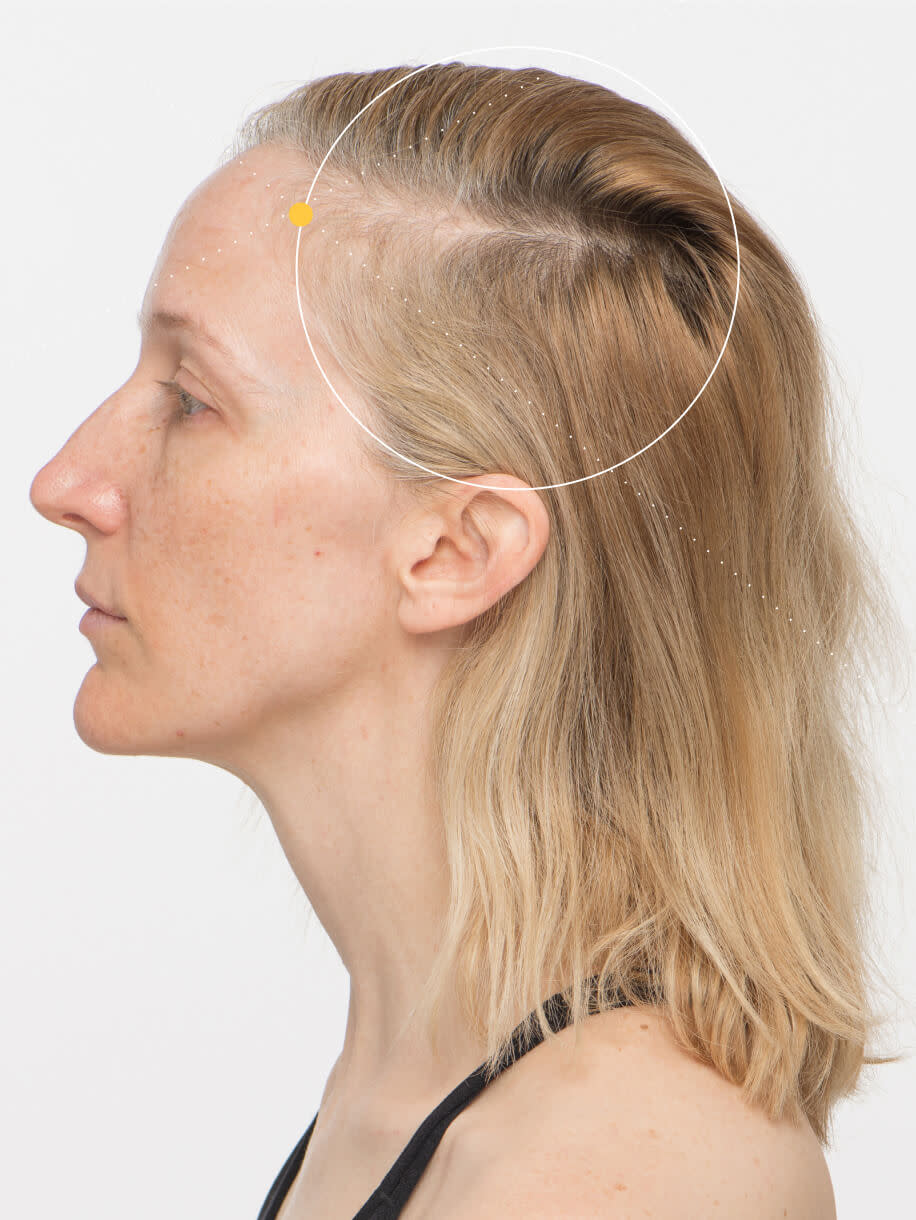 Tanya before taking Nutrafol Women Hair Growth Nutraceutical.