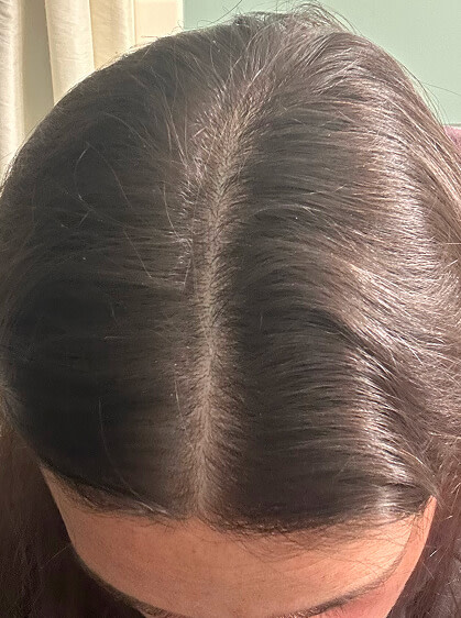 Lisa 5 months into taking Nutrafol Women Hair Growth Nutraceutical. Results are from a clinical study and may vary