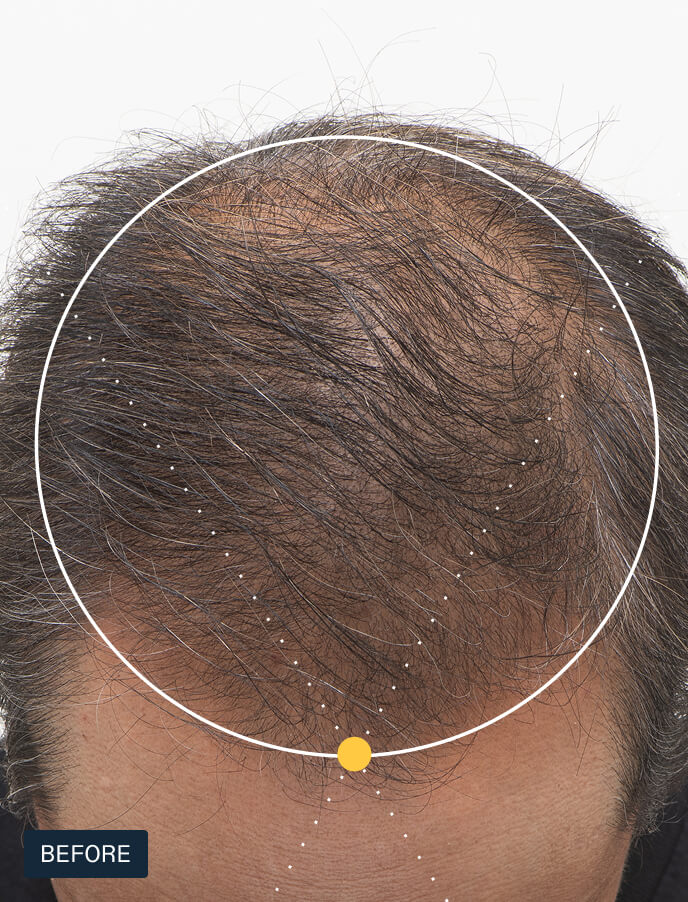 Participants Before taking Nutrafol Men.